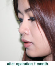 plastic_surgery_augmentation_rhinoplasty